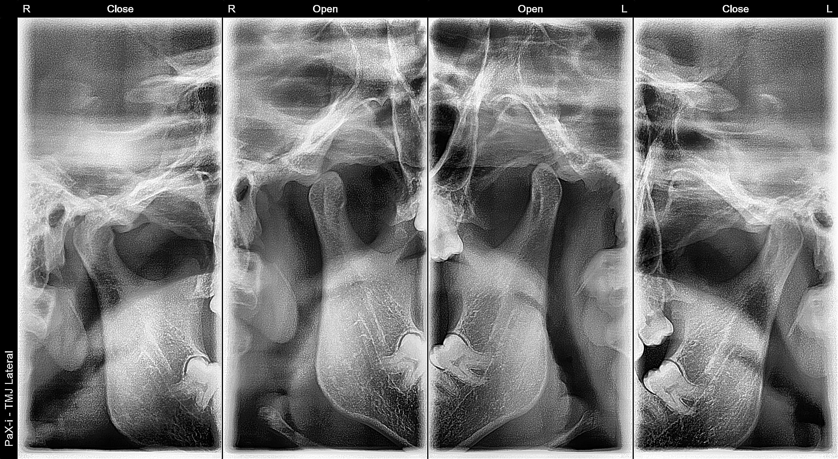 Estudio radiográfico de articulación temporomandibular