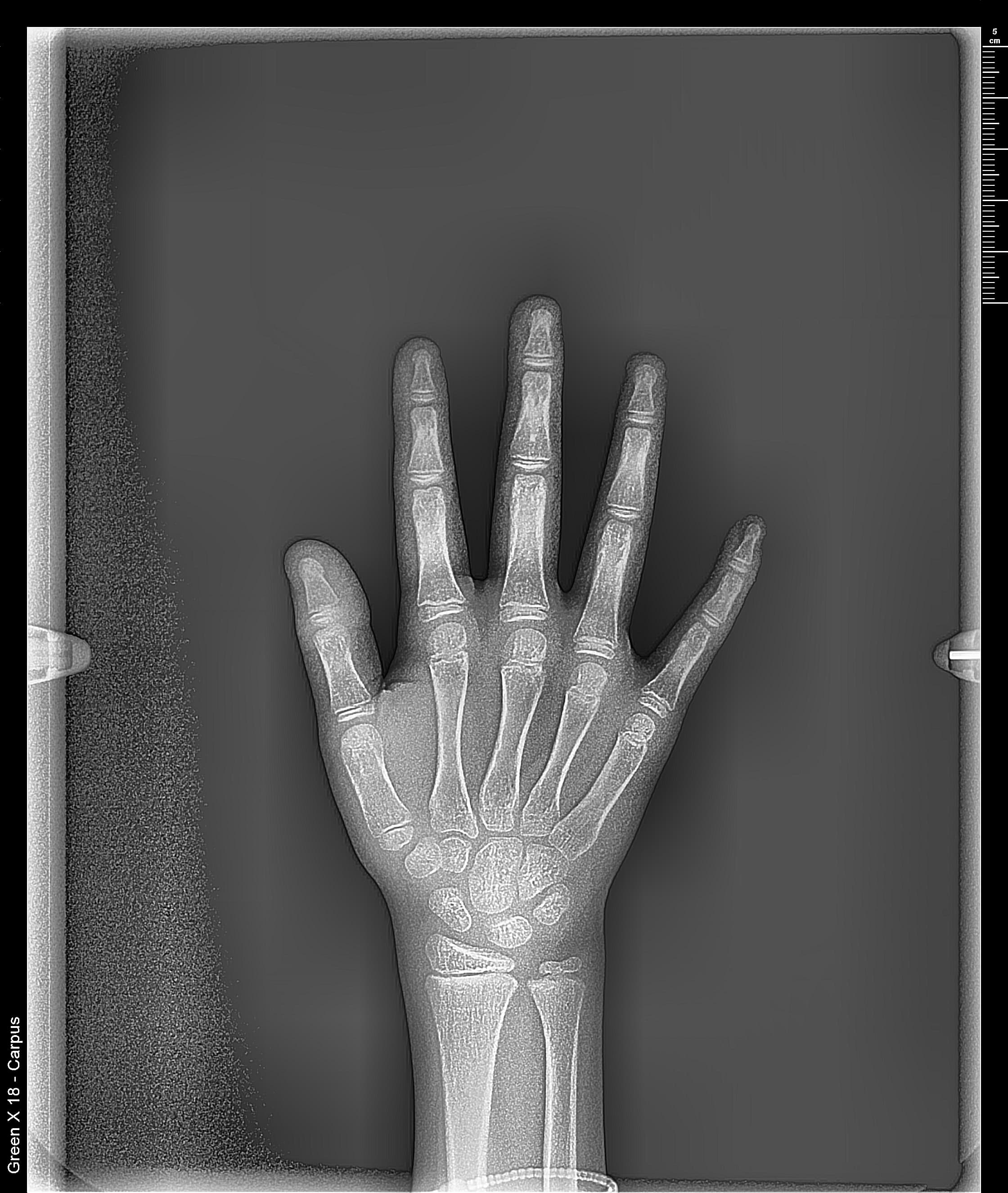 Radiografía carpal de mano y muñeca