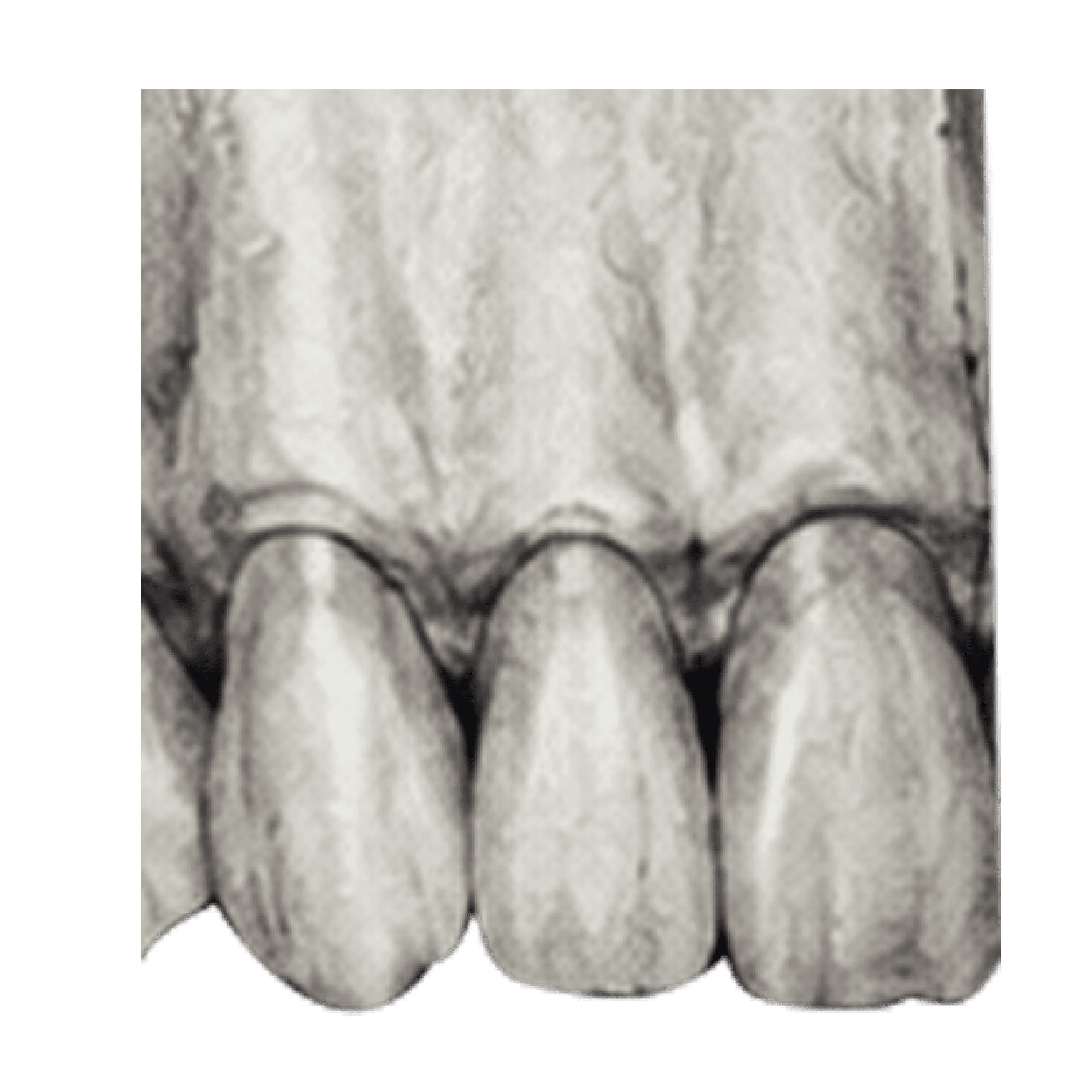 Campo de visión CBCT de 4 por 4 centímetros