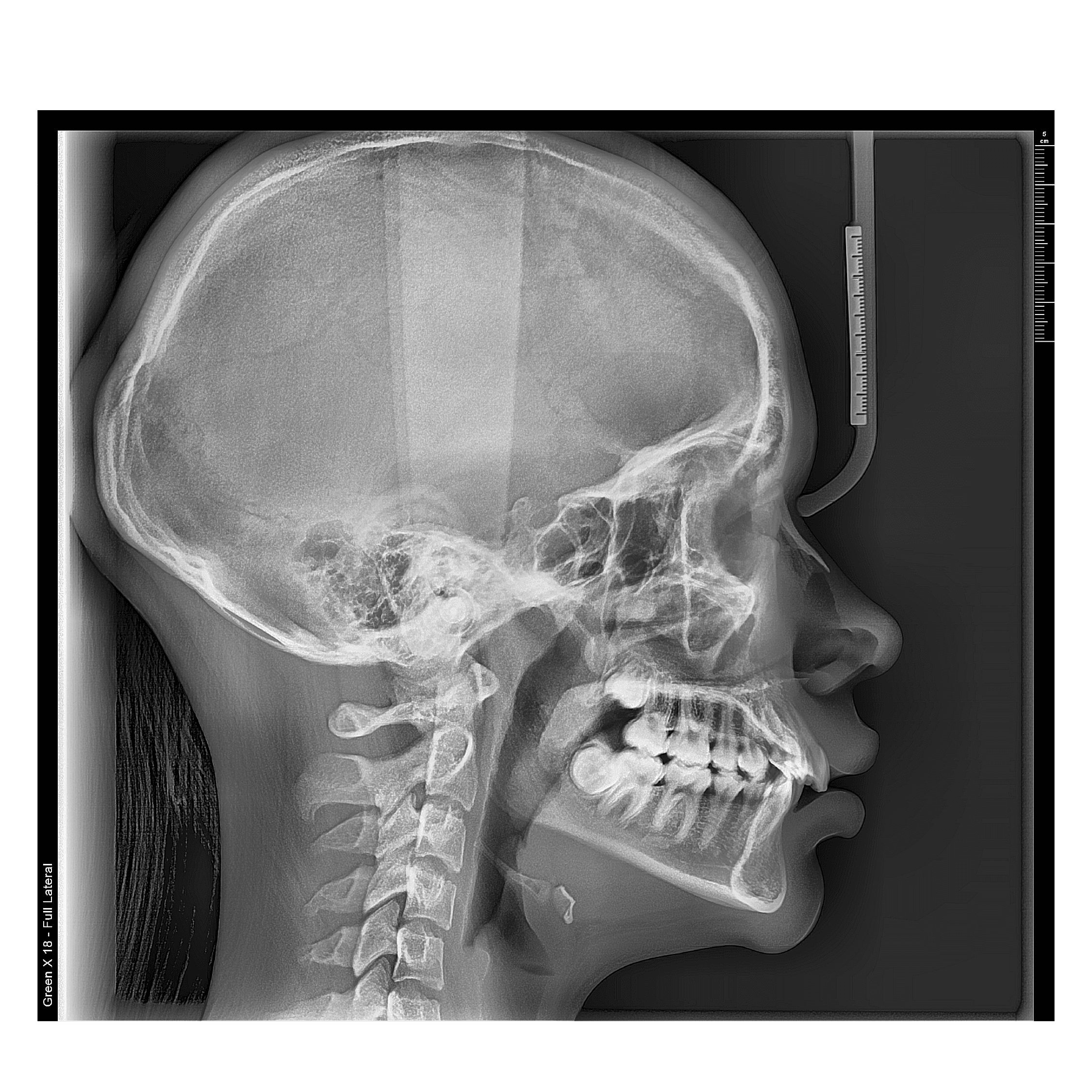 Radiografía lateral de cráneo
