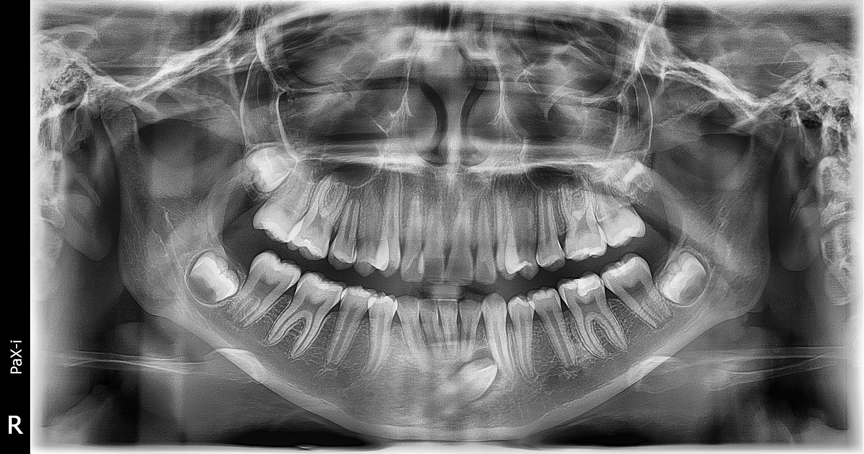 Radiografía panorámica dental
