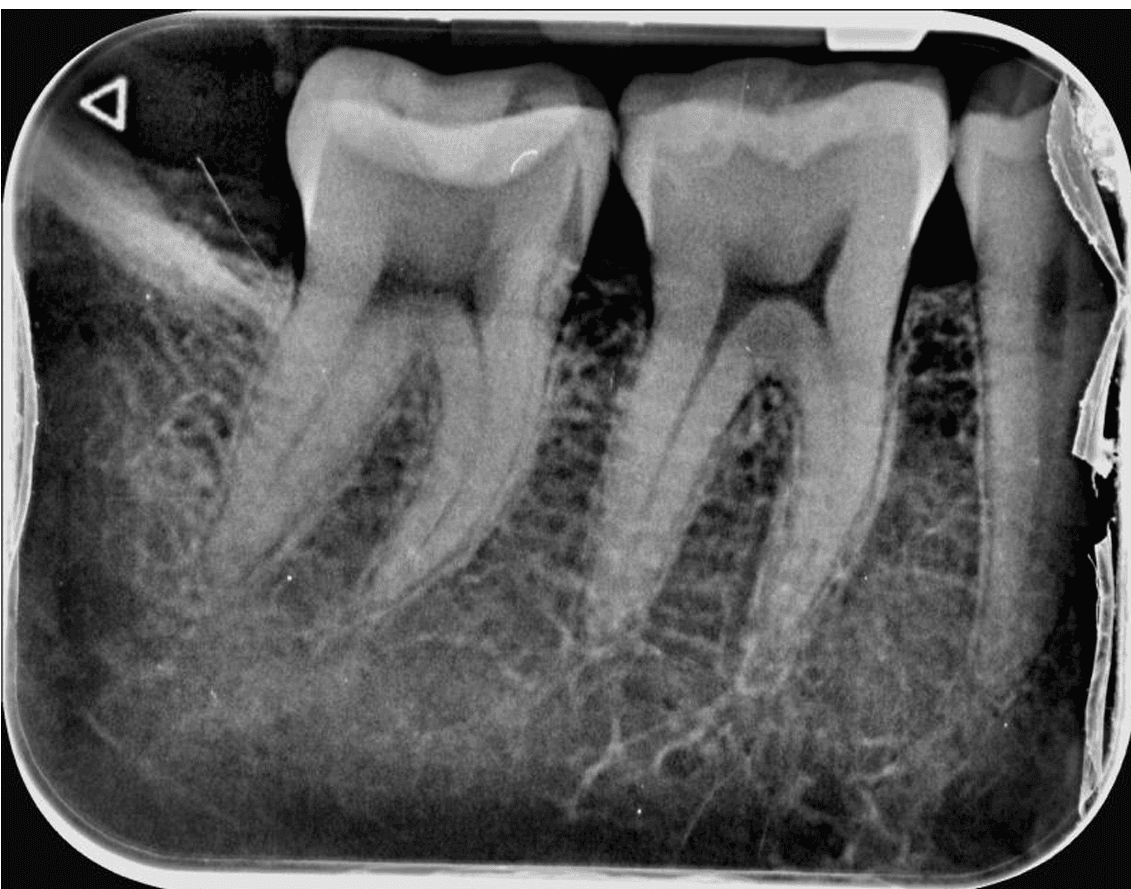 Radiografía intraoral periapical