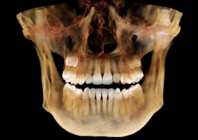 Tomografía CBCT en proyección AP