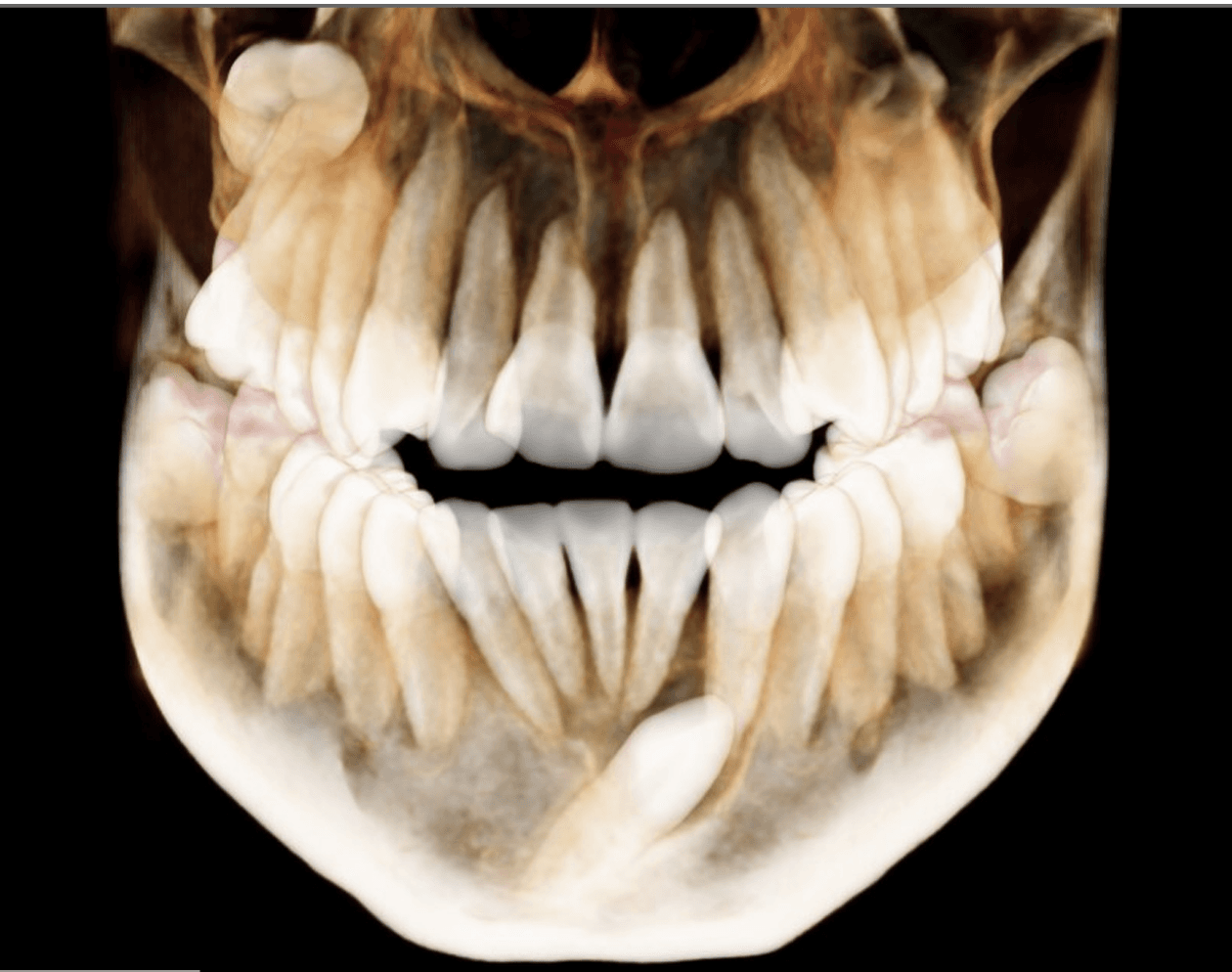 Tomografía CBCT Cone Beam dental